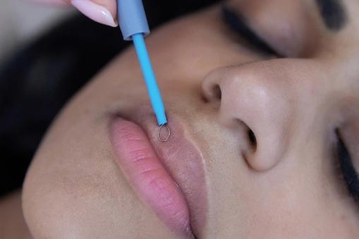 Q SKIN RESURFACING